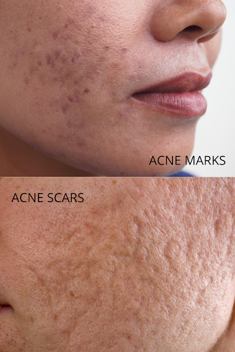 acne scars vs acne marks