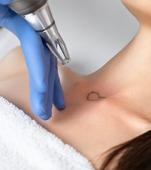 treatment tattoo removal