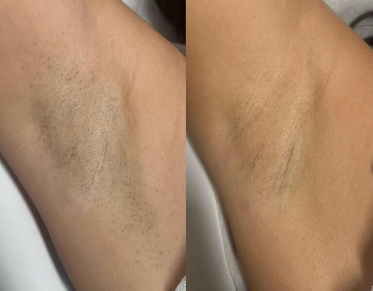 laser hair removal