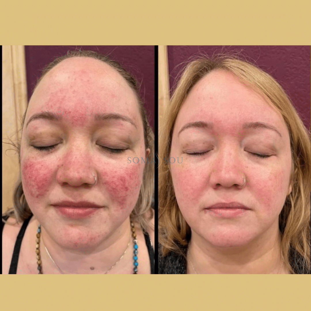 Before and After Image: Acne Scar Recovery - front