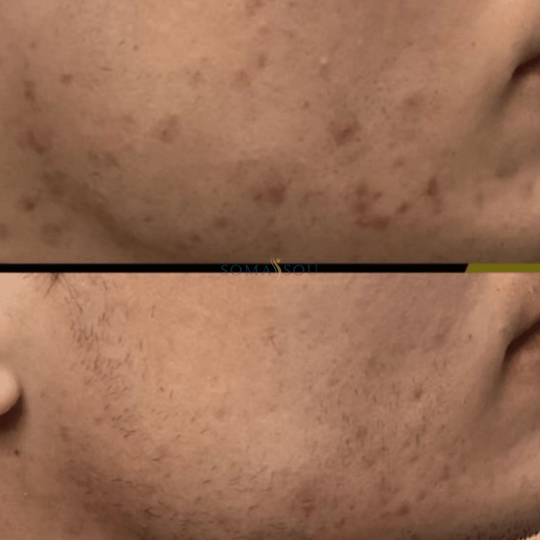 Before and After Image: Acne Scar Recovery - right-side