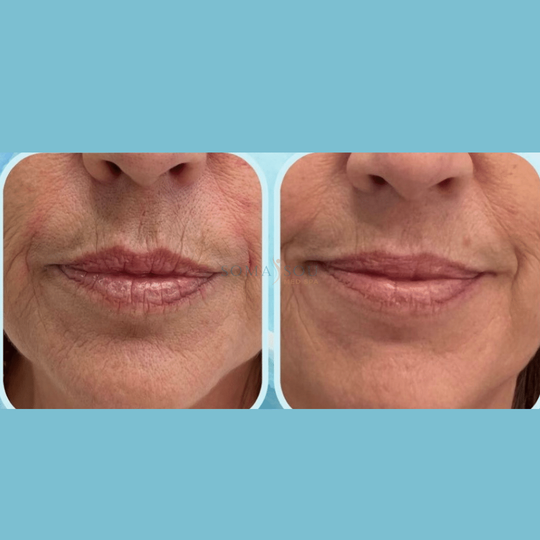 Before and After Image: Lips You’ll Love - front