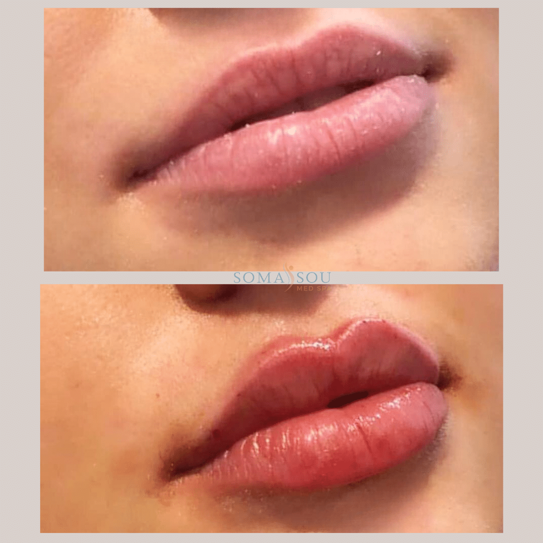 Before and After Image: Lips You’ll Love - right-front-oblique