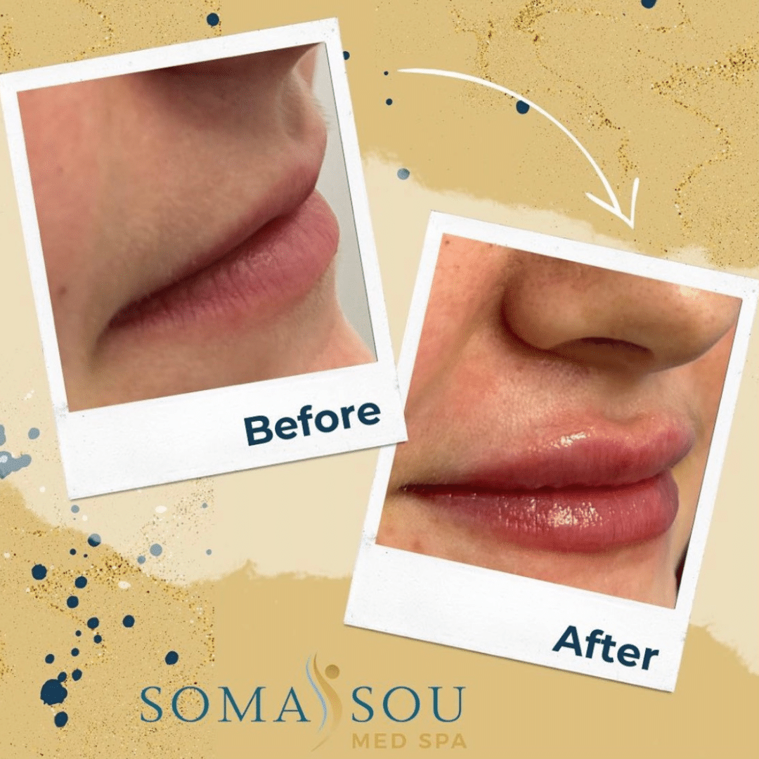 Before and After Image: Lips You’ll Love - front