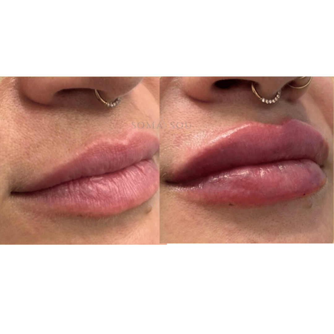 Before and After Image: Lips You’ll Love - right-front-oblique