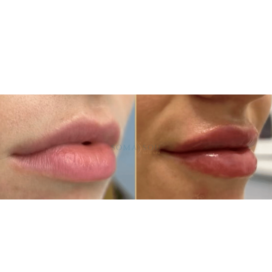 Before and After Image: Lips You’ll Love - right-front-oblique