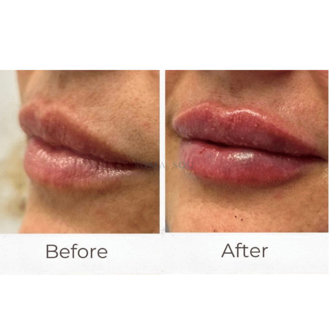 Before and After Image: Lips You’ll Love - left-front-oblique