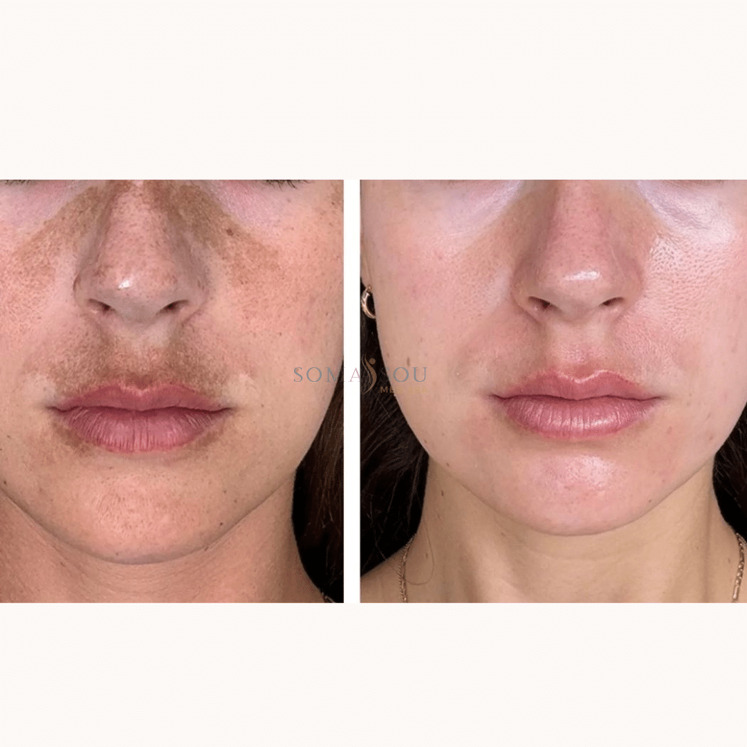 Before and After Image: Melasma - front