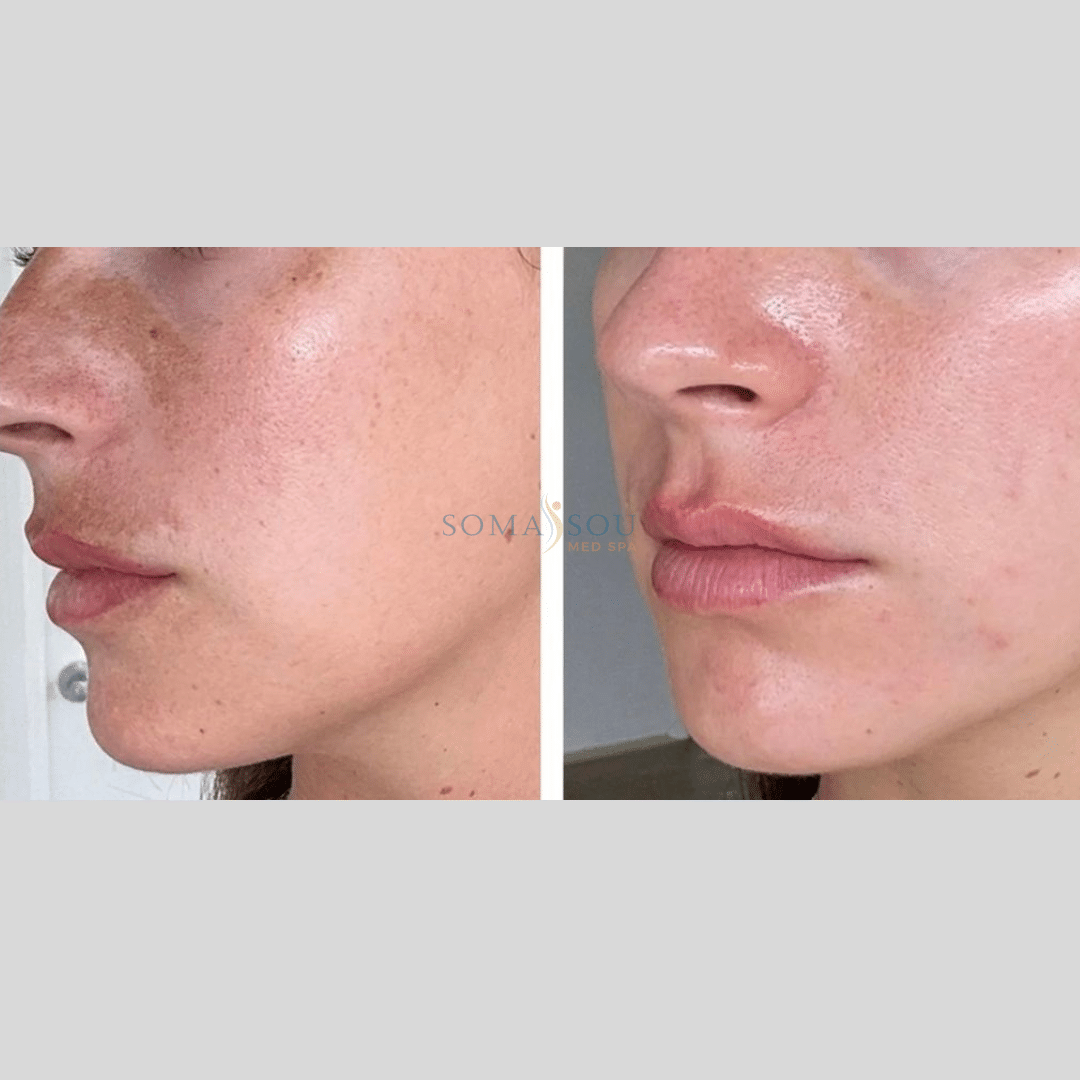 Before and After Image: Melasma - left-front-oblique