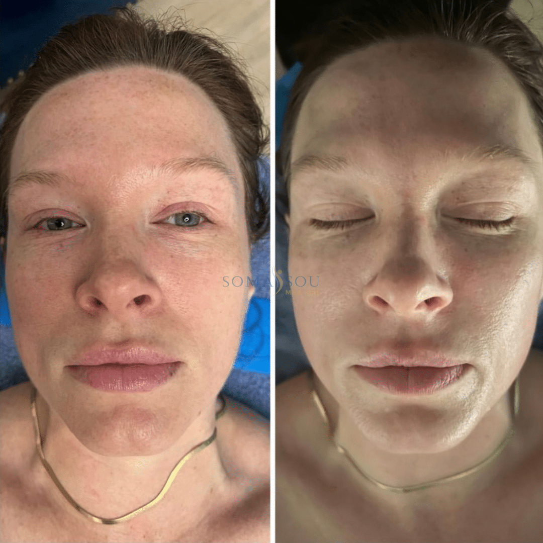 Before and After Image: Rejuvenated Skin - front