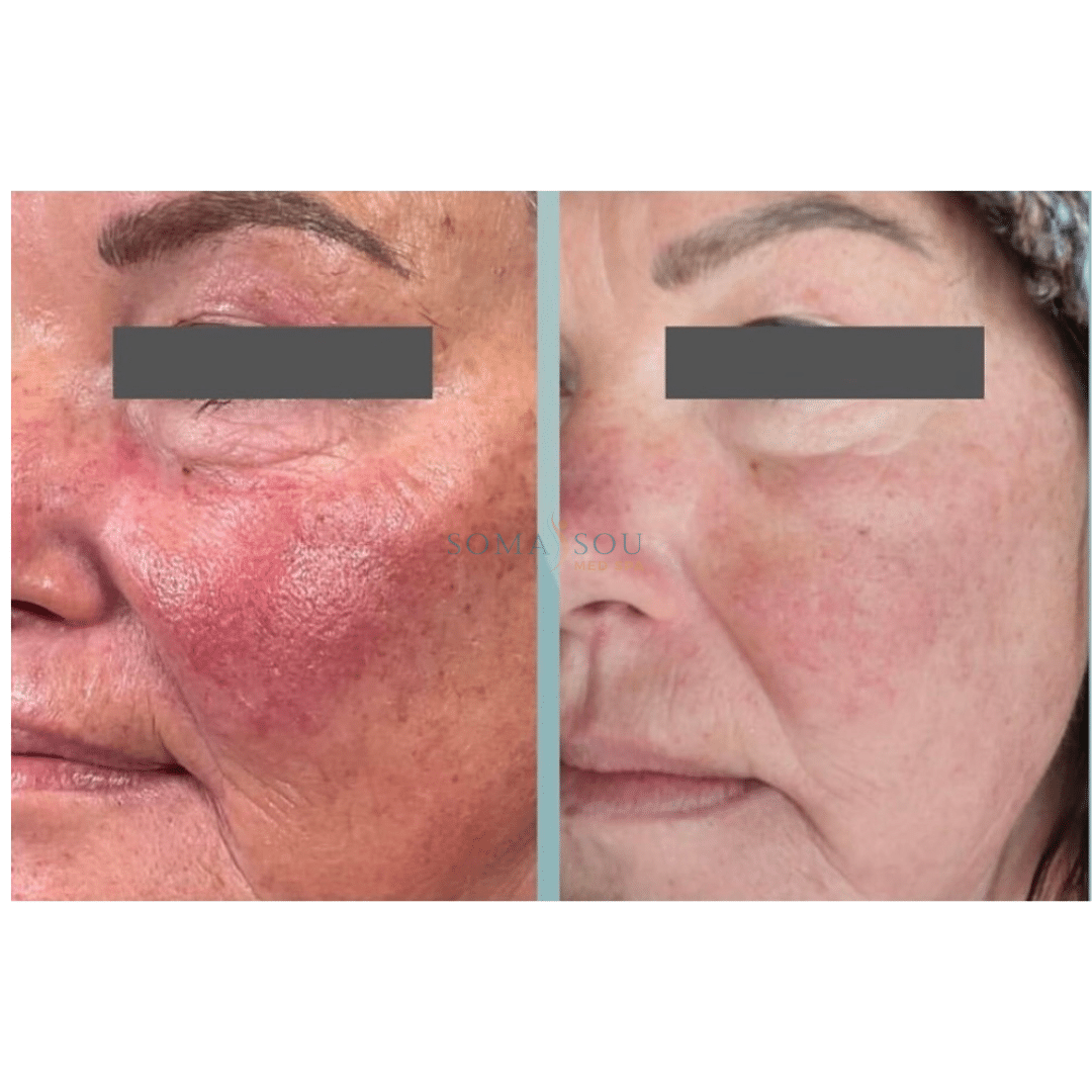 Before and After Image: Rejuvenated Skin - left-front-oblique