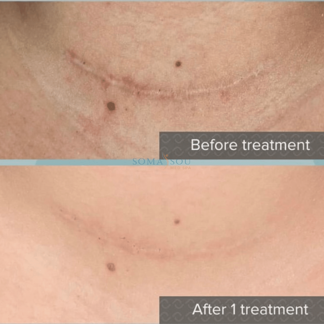 Before and After Image: Rejuvenated Skin - front