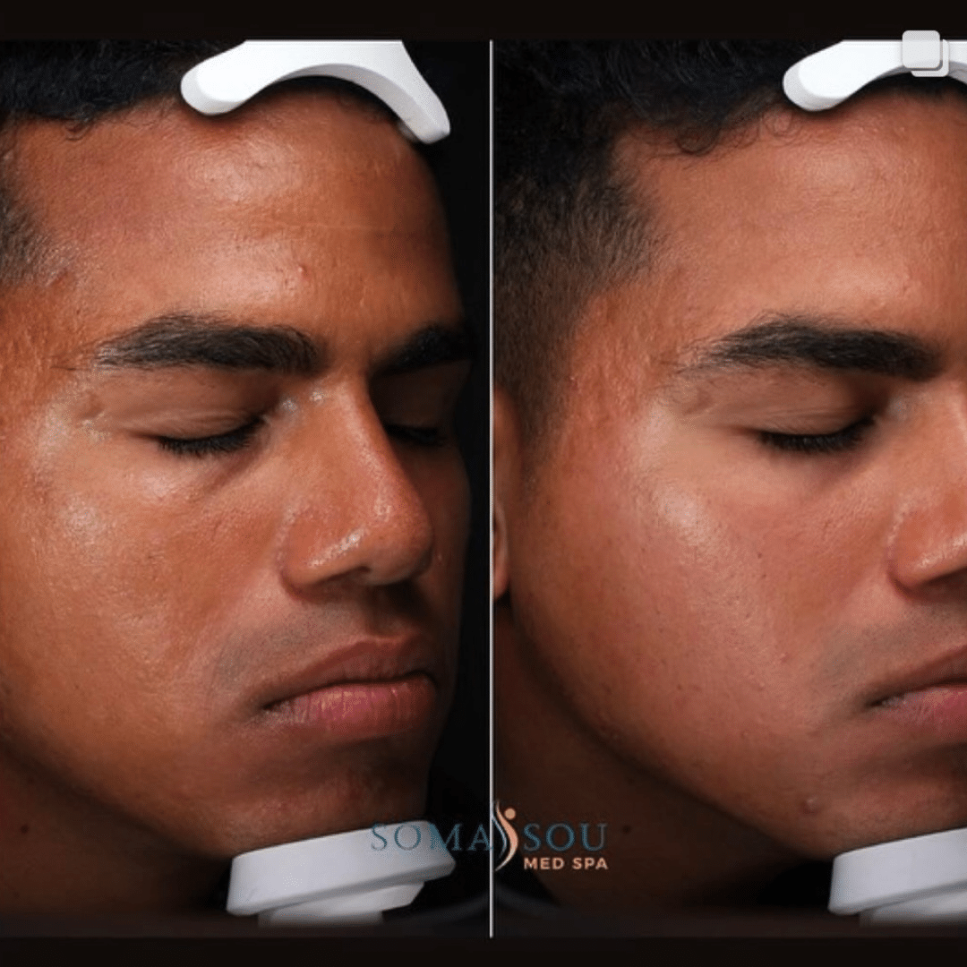 Before and After Image: Rejuvenated Skin - right-front-oblique