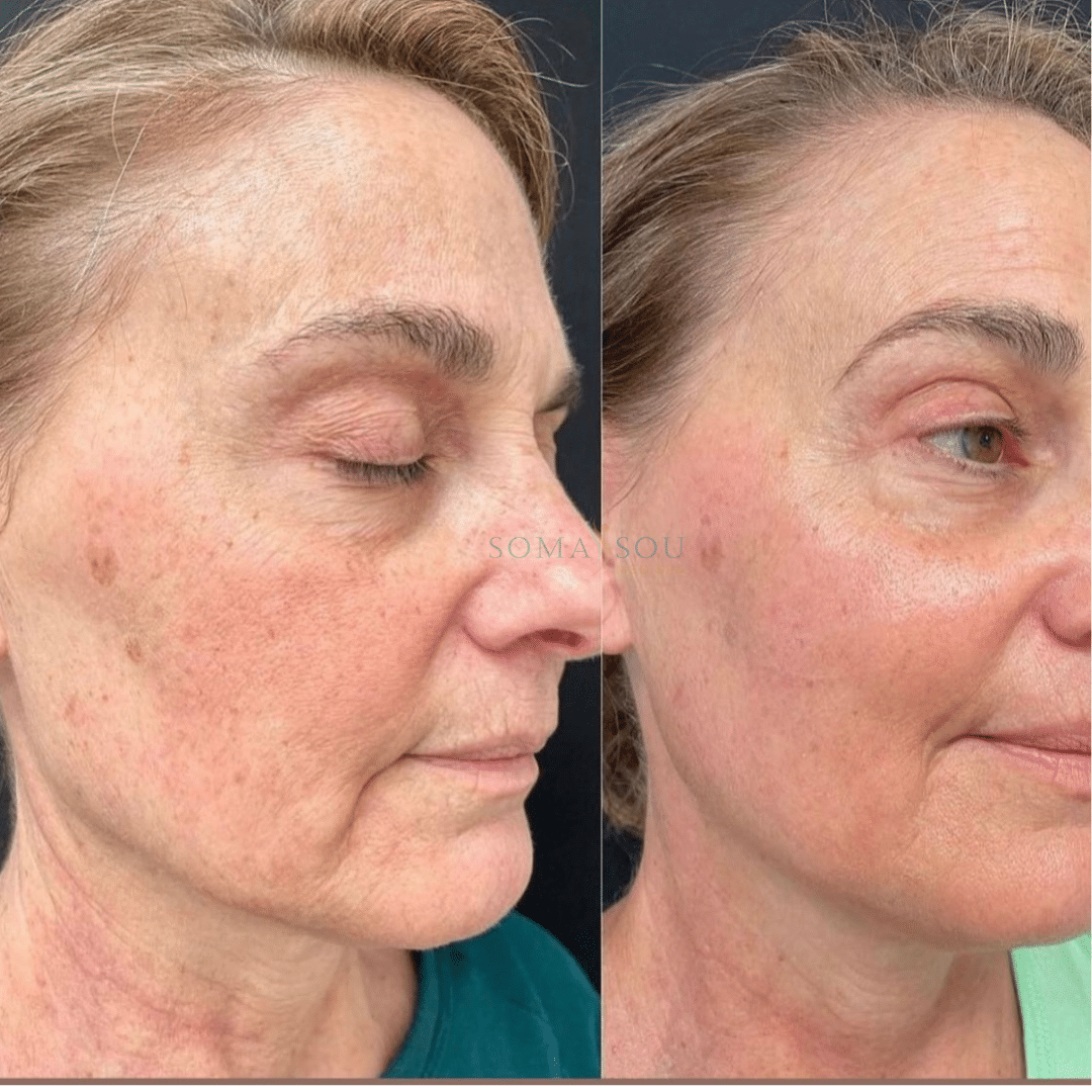 Before and After Image: Rejuvenated Skin