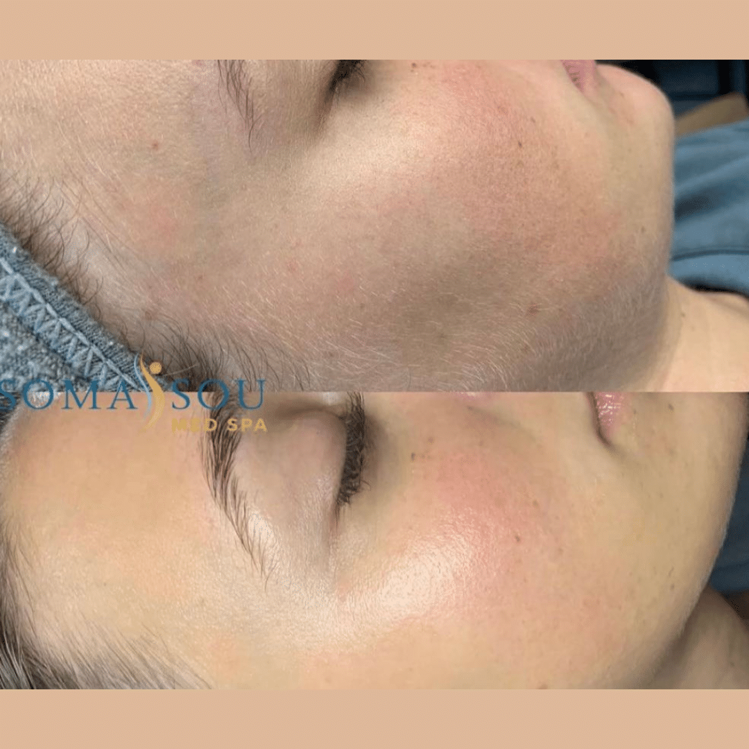 Before and After Image: Rejuvenated Skin