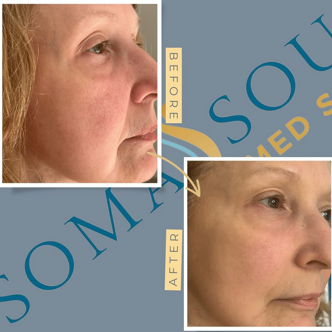 Before and After Image: Rejuvenated Skin - right-front-oblique