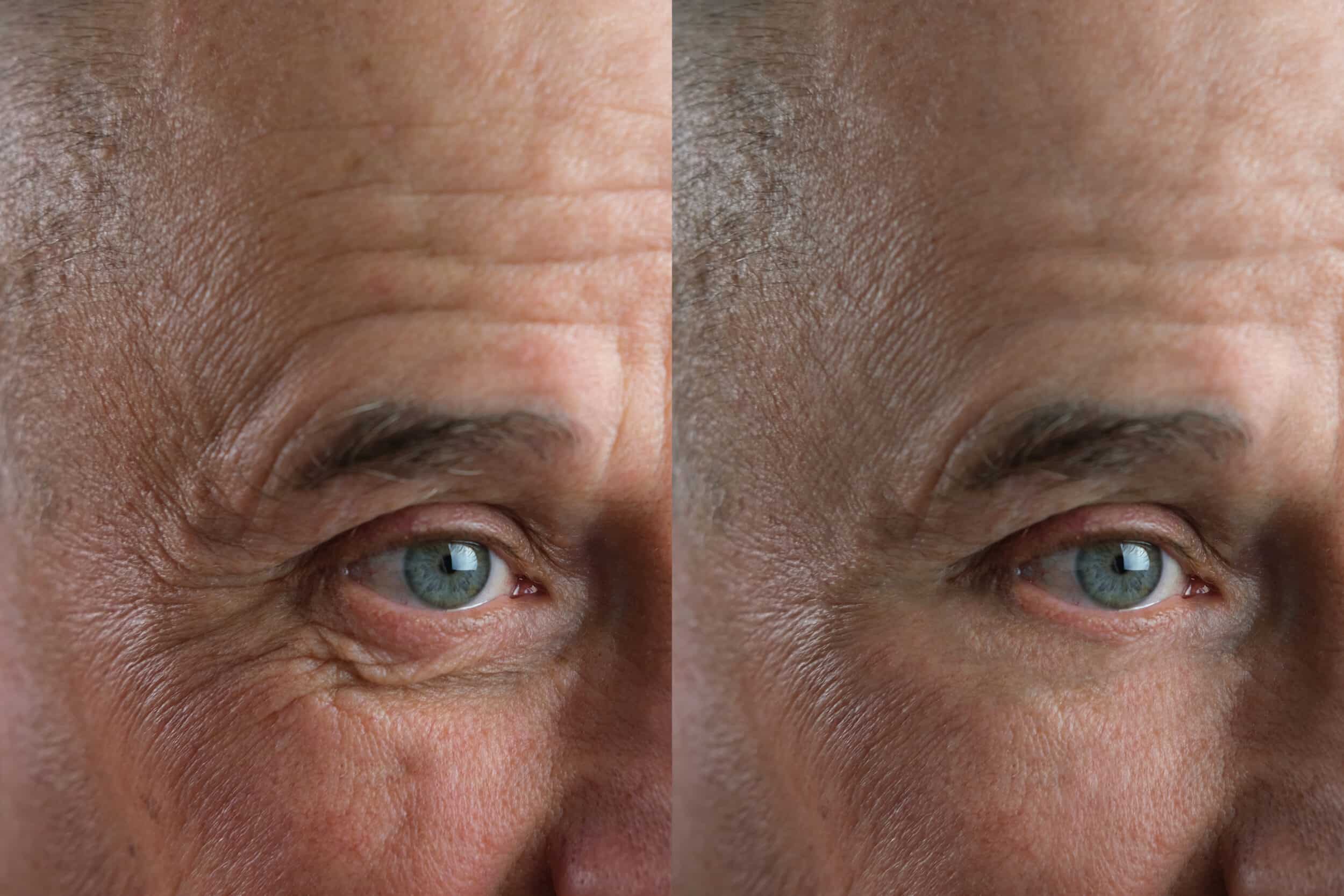 Before and After Image: Botox - right-front-oblique