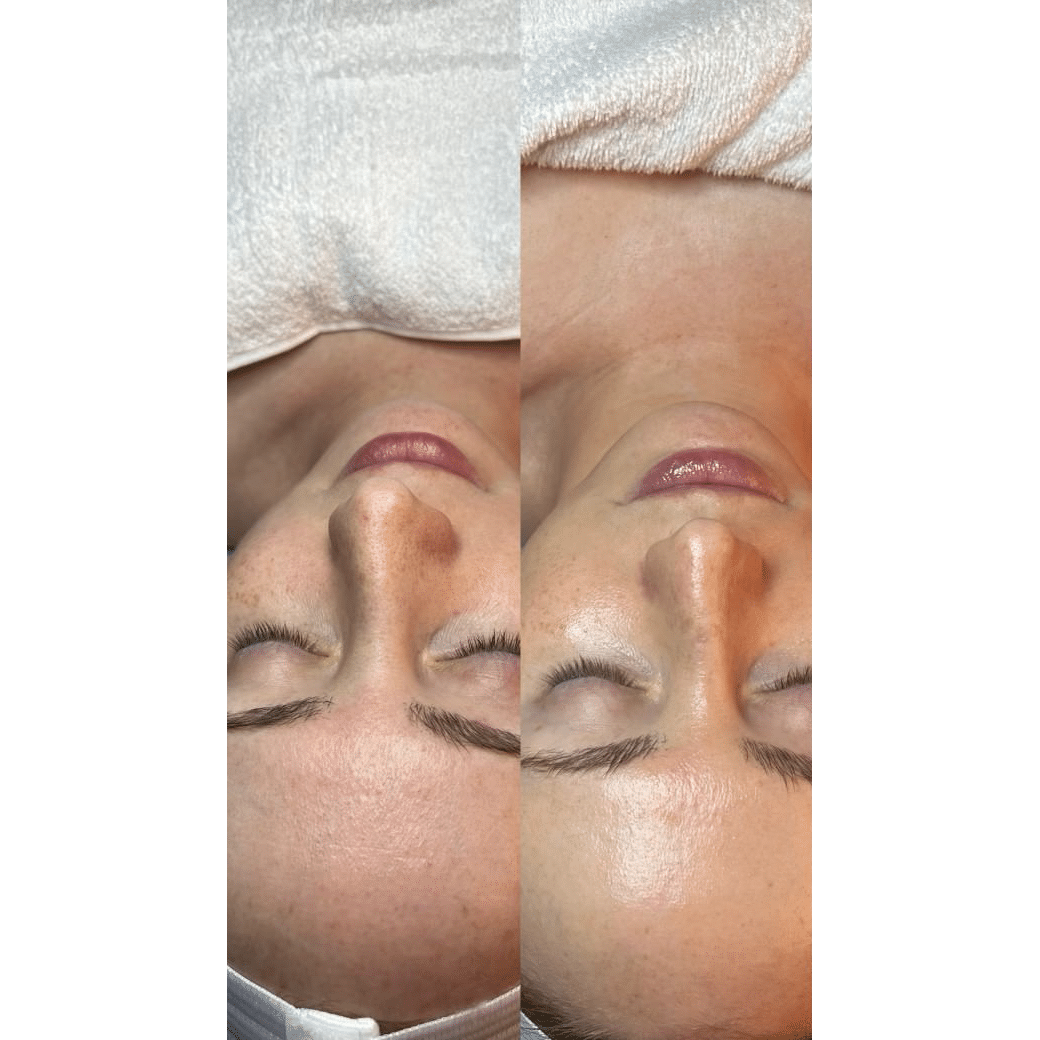 Before and After Image: Facial - front