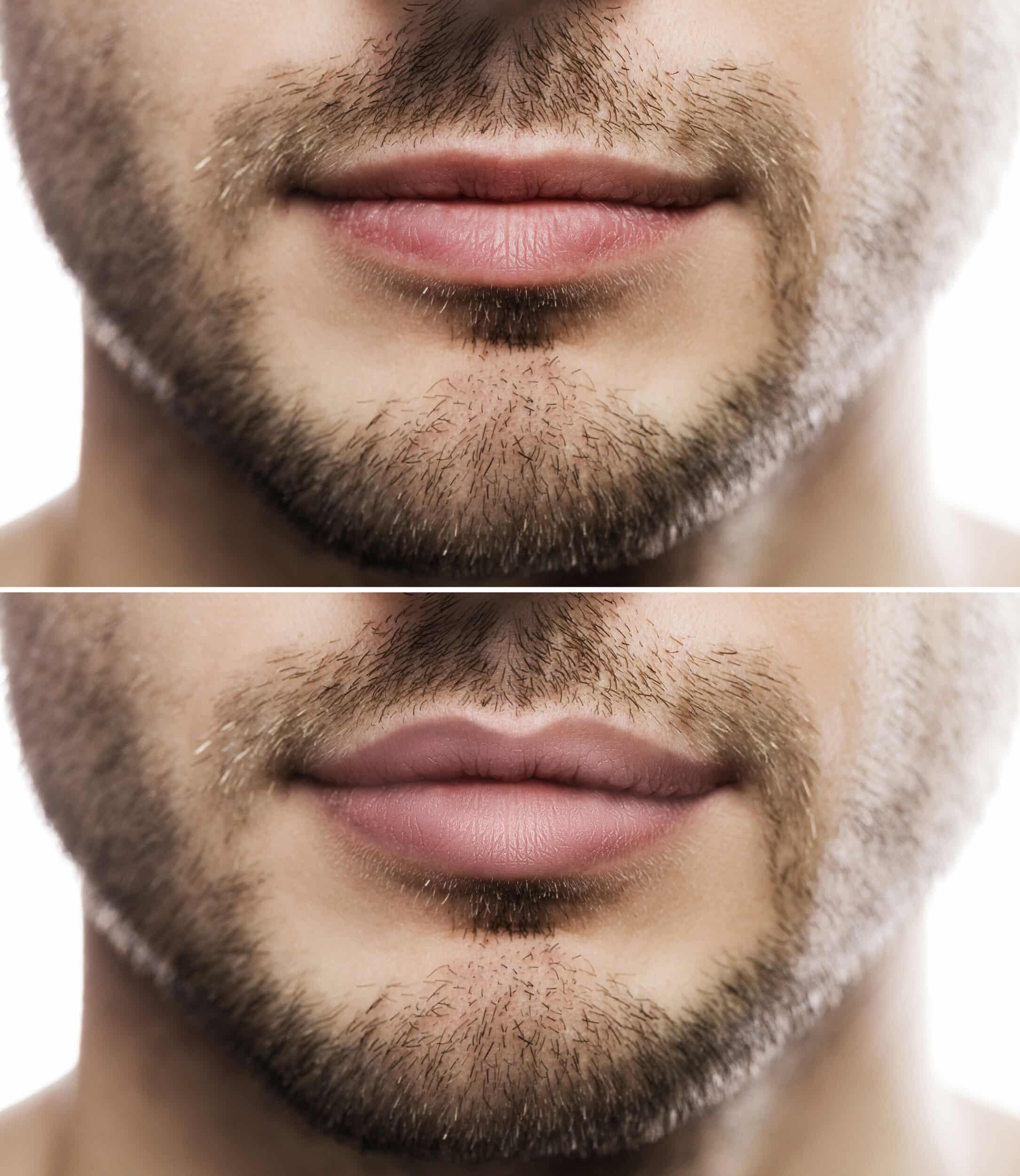 Before and After Image: Lip Filler - front