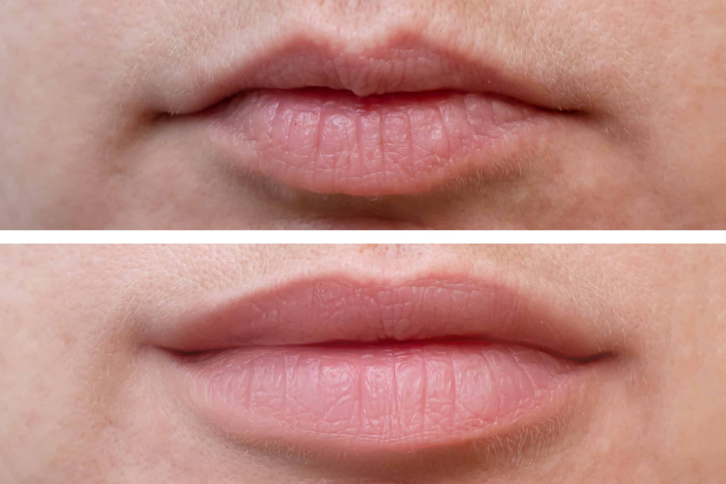 Before and After Image: Lip Filler - front