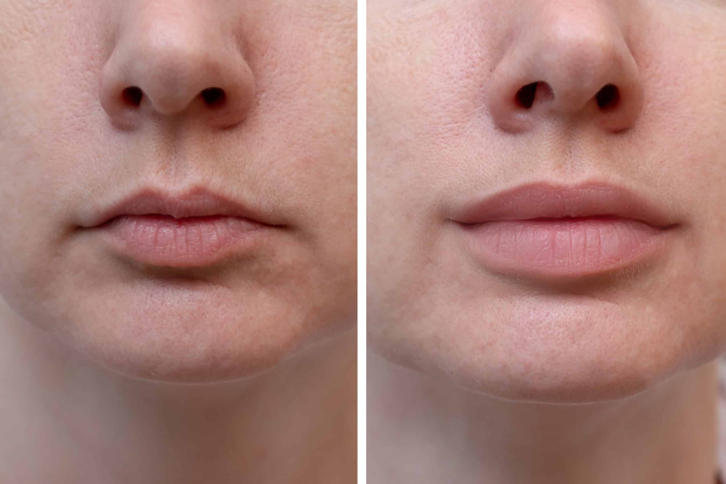 Before and After Image: Lip Filler - front