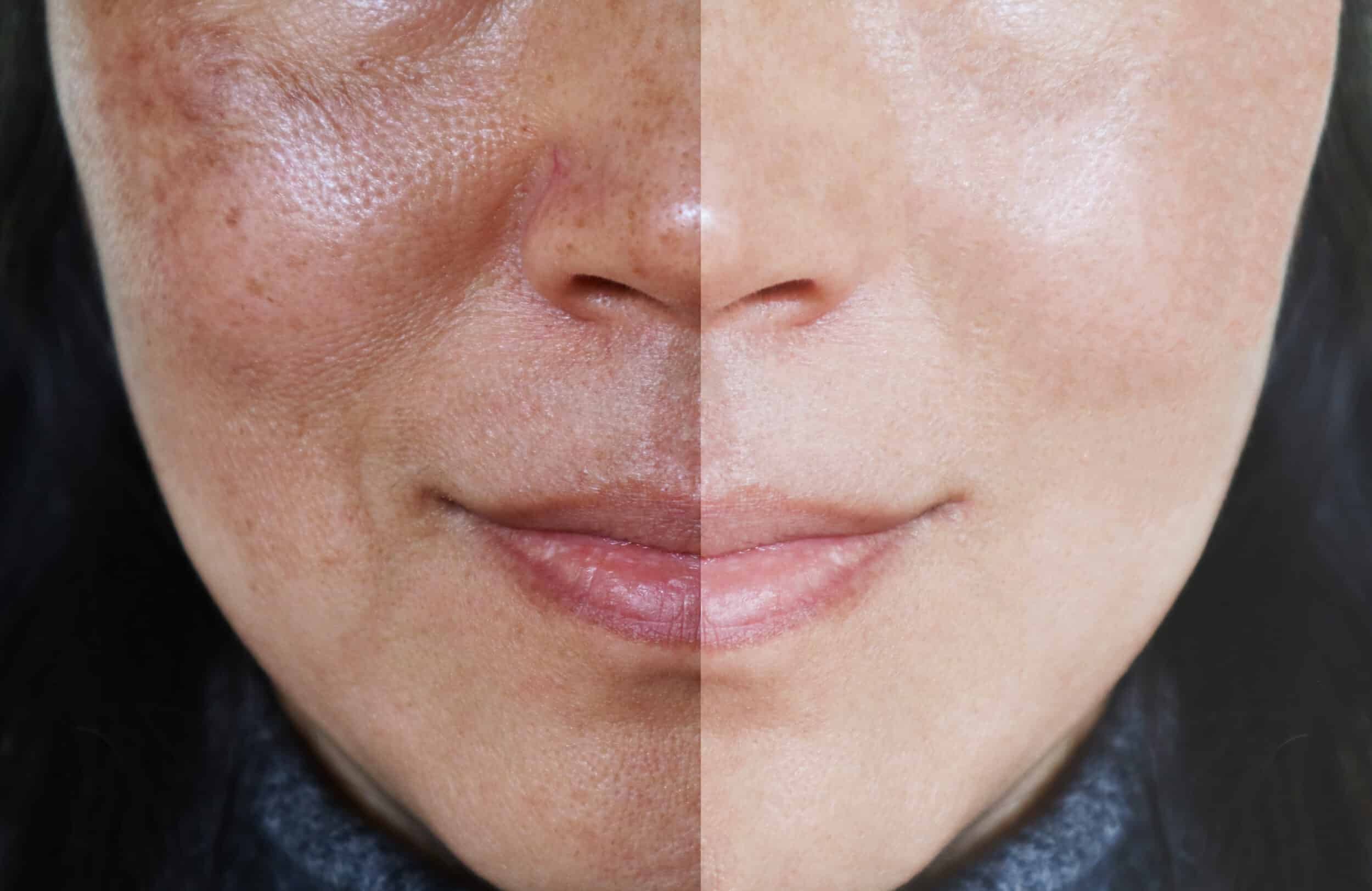 Before and After Image: Melasma - front