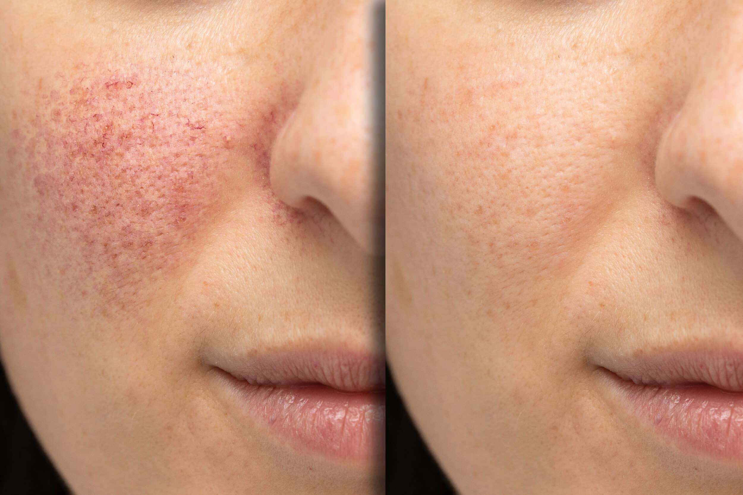 Before and After Image: Rosacea - front