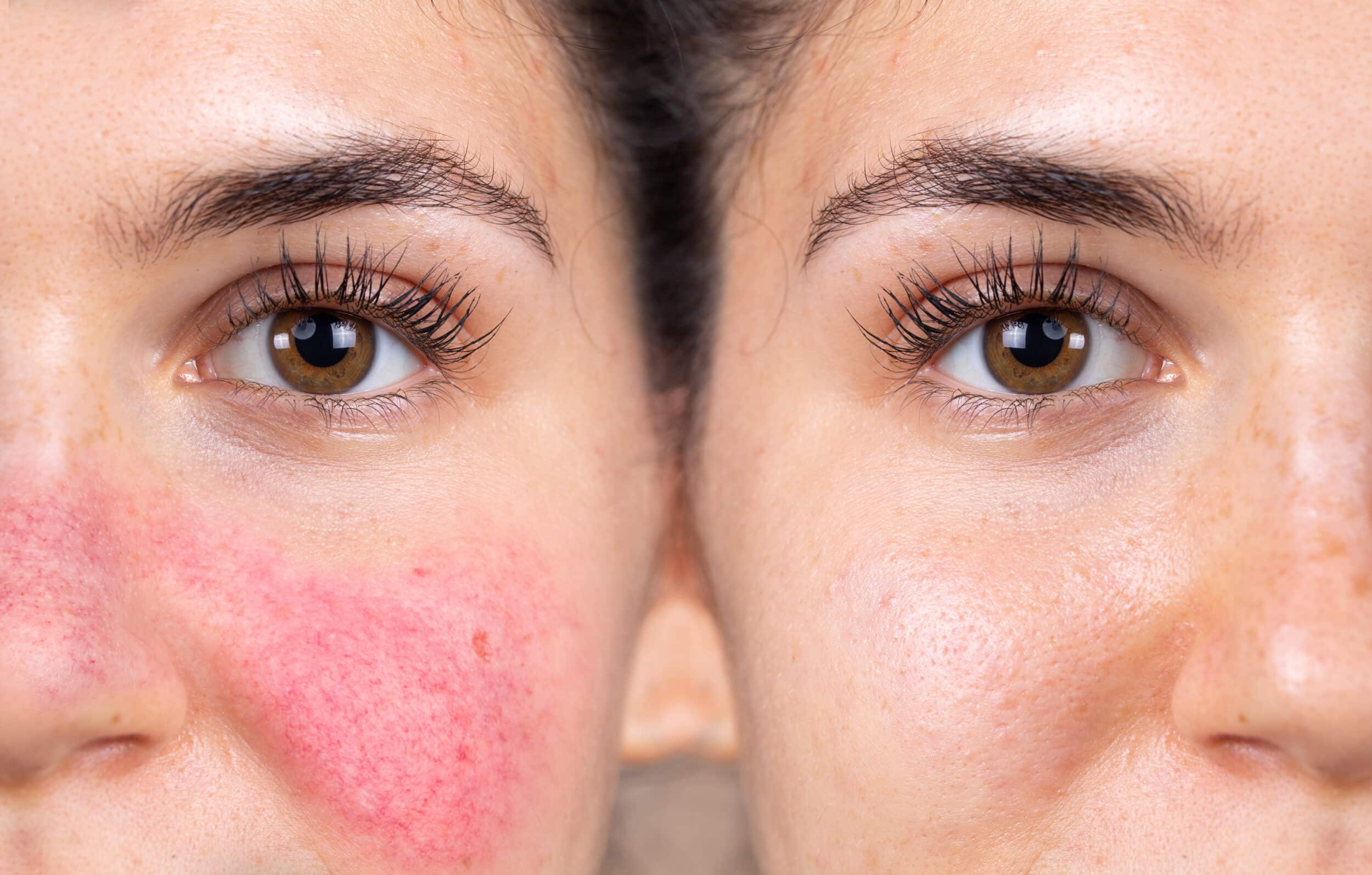 Before and After Image: Rosacea - front