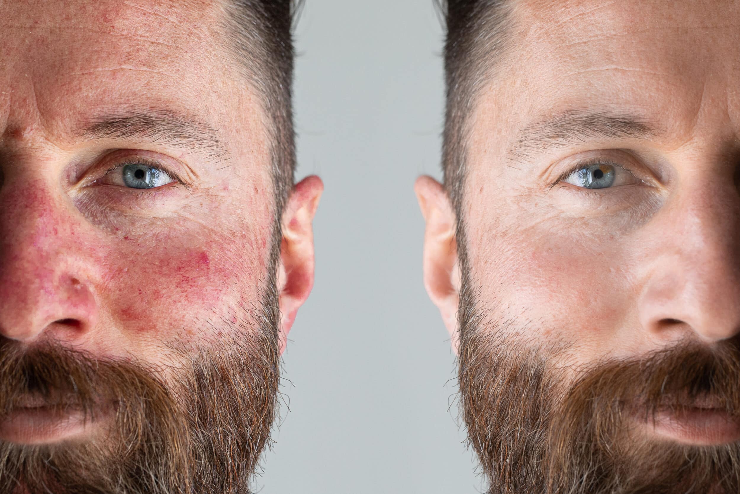 Before and After Image: Rosacea - front