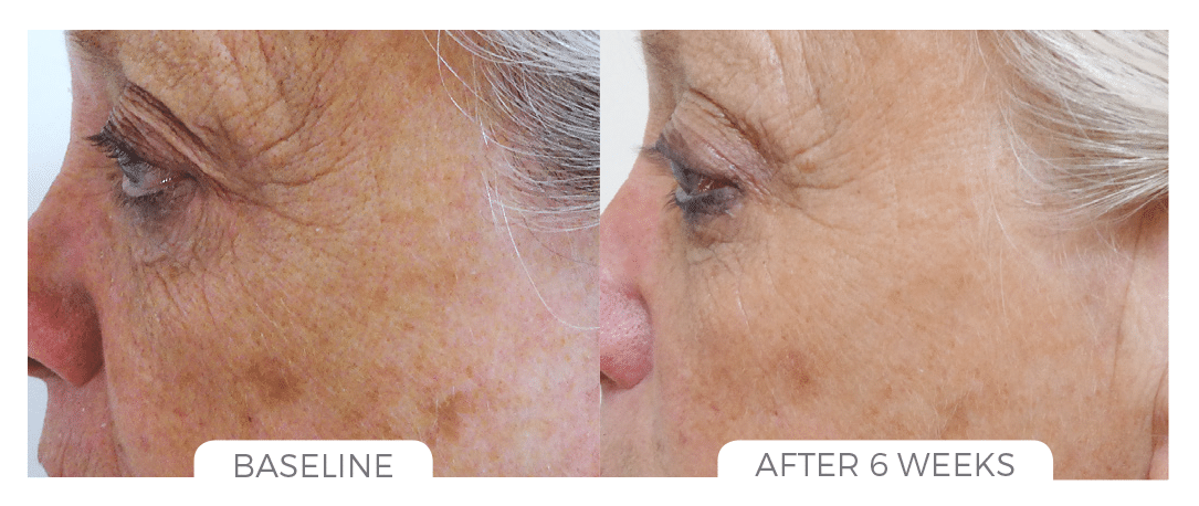 Before and After Image: Skin Brightening System - left-side