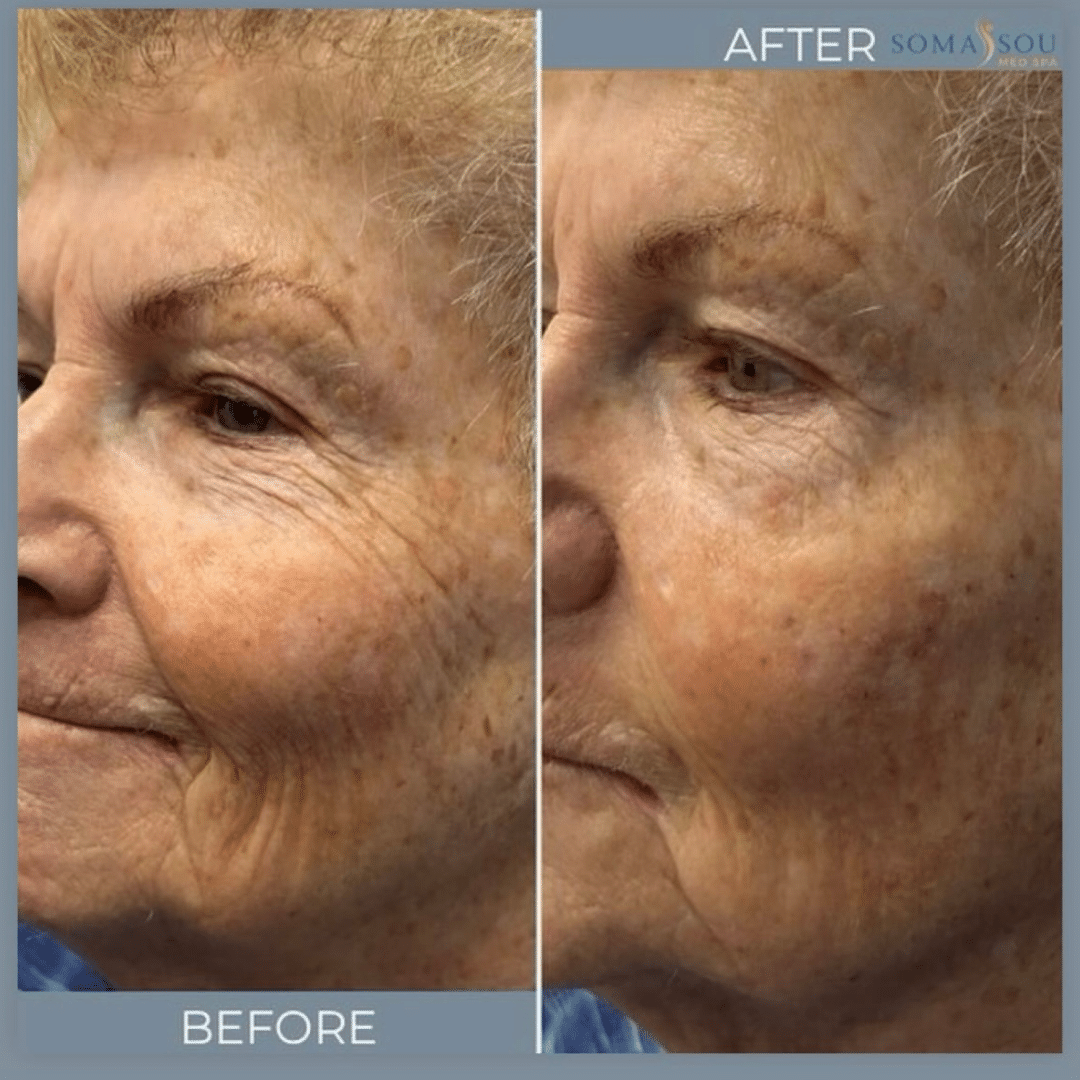 Before and After Image: Skin Tightening - left-front-oblique