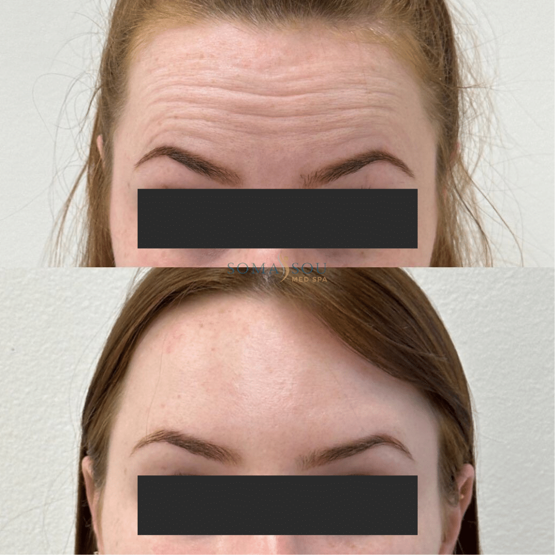 Before and After Image: Skin Tightening - front