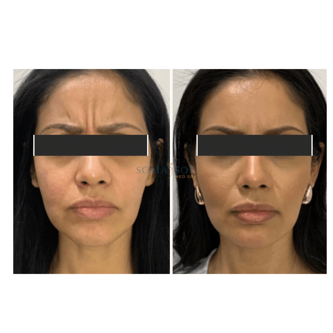 Before and After Image: Skin Tightening - front