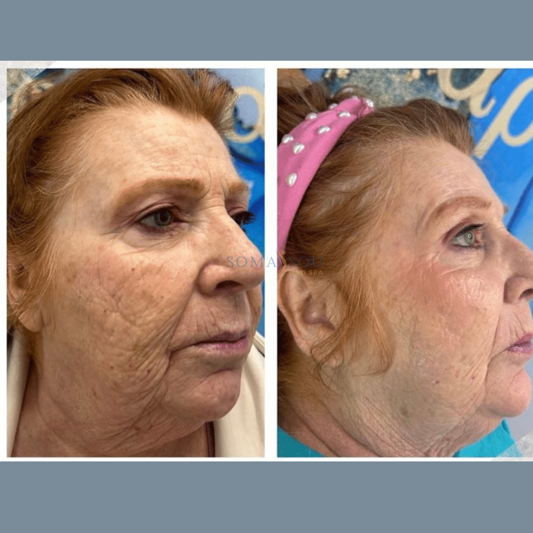 Before and After Image: Skin Tightening - right-front-oblique