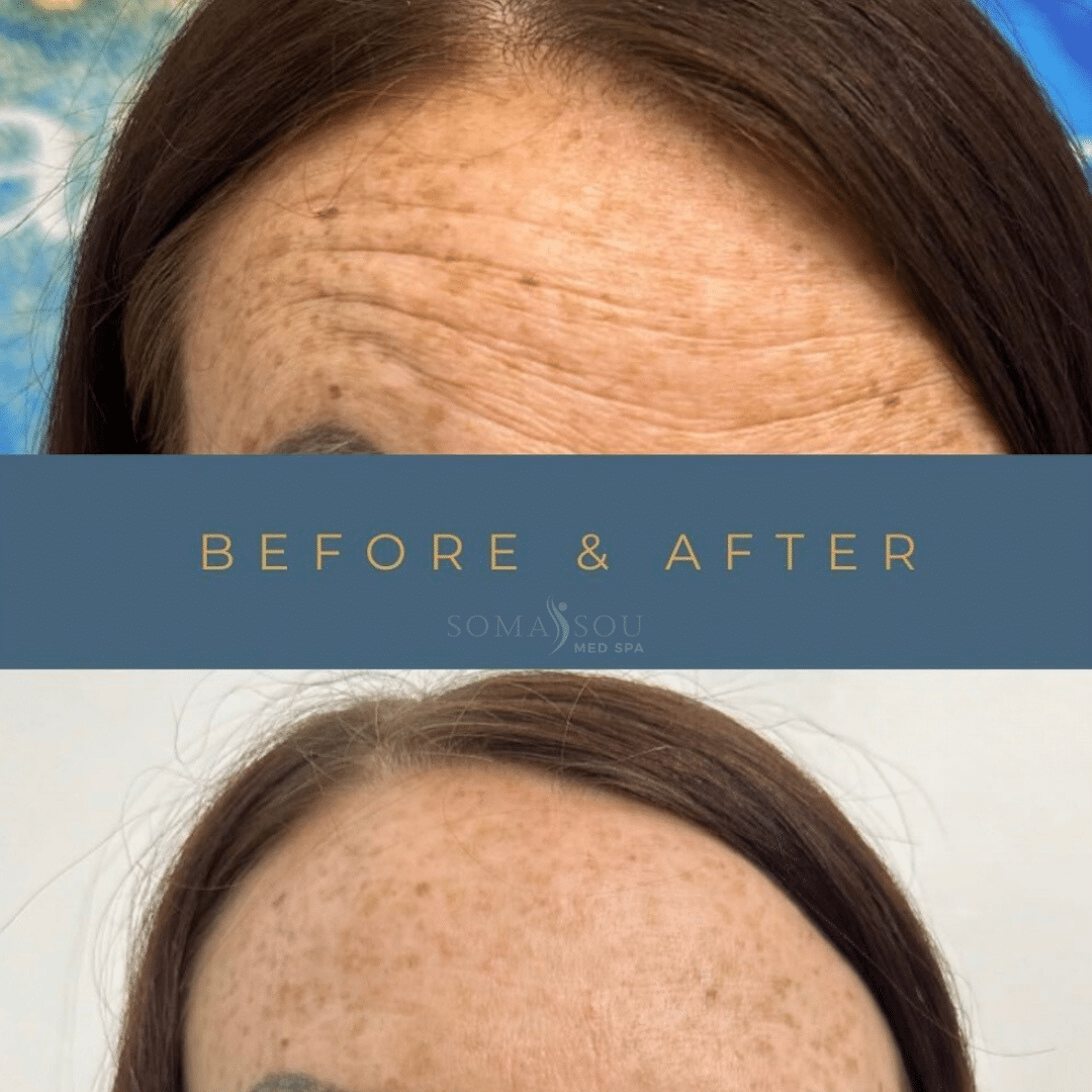 Before and After Image: Skin Tightening - front