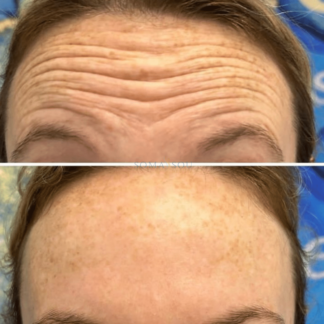 Before and After Image: Skin Tightening - front