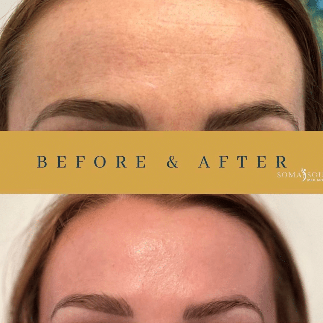 Before and After Image: Skin Tightening - front