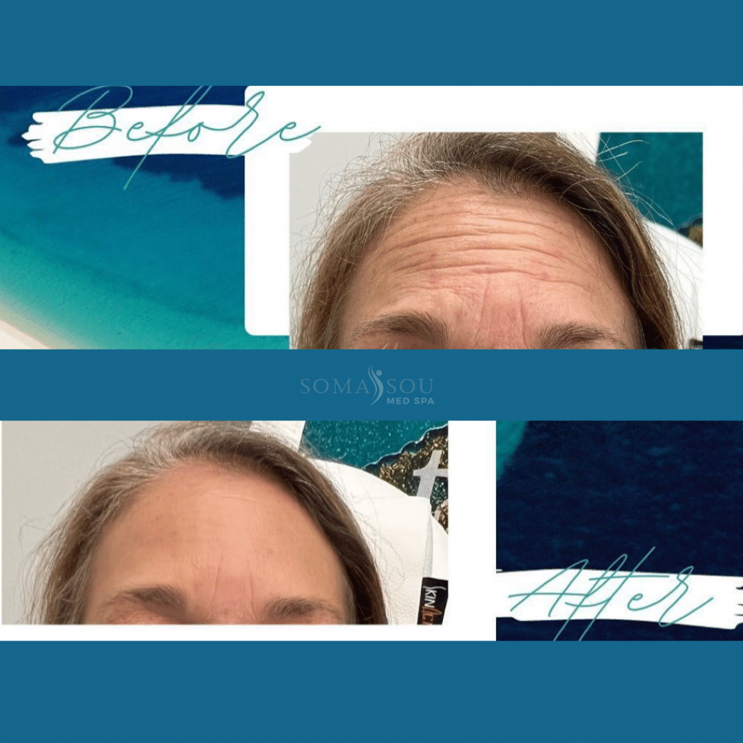 Before and After Image: Skin Tightening - front