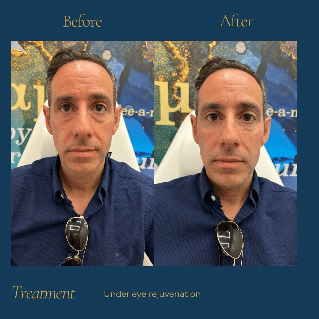 Before and After Image: Skin Tightening - front